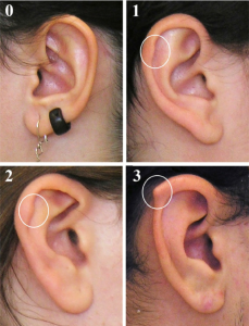 Variabilidad del Tubérculo de Darwin en la punta De la oreja (0= ausente). Puede presentarse en otras zonas del pabellón auditivo: ver publicación.
